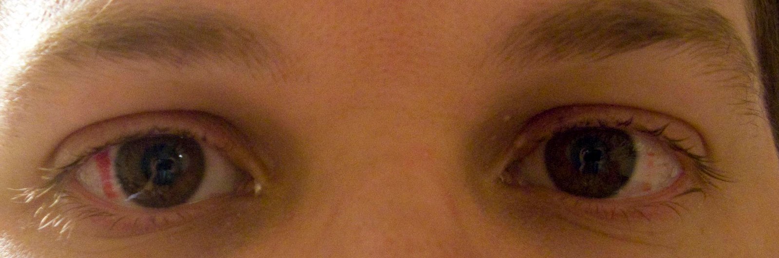 How Long Does It Take To Recover From LASIK