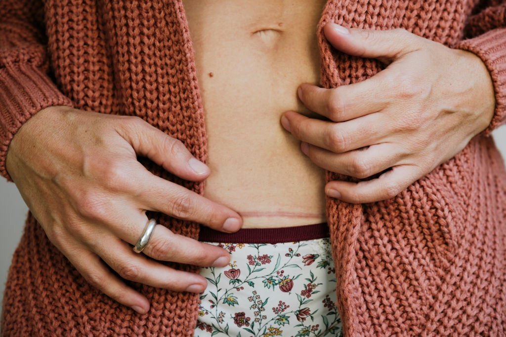 When Can I Start Bending After C-section? - CloudMineInc