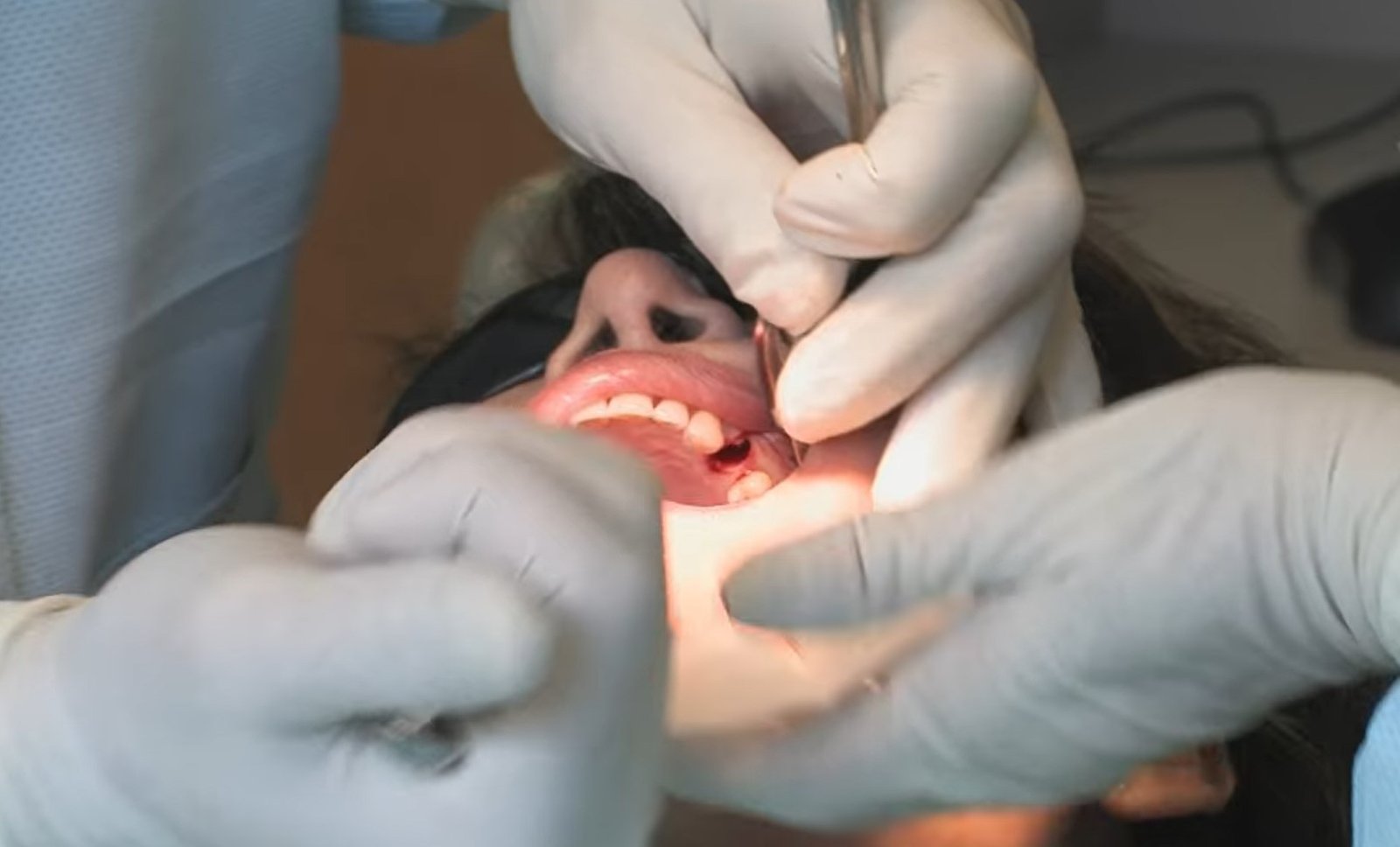 How Can I Make My Tooth Extraction Heal Faster? - CloudMineInc