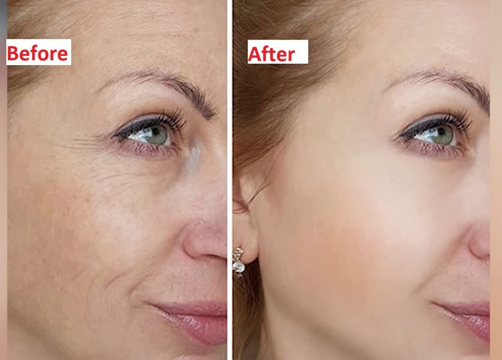micro needling before and after results 1