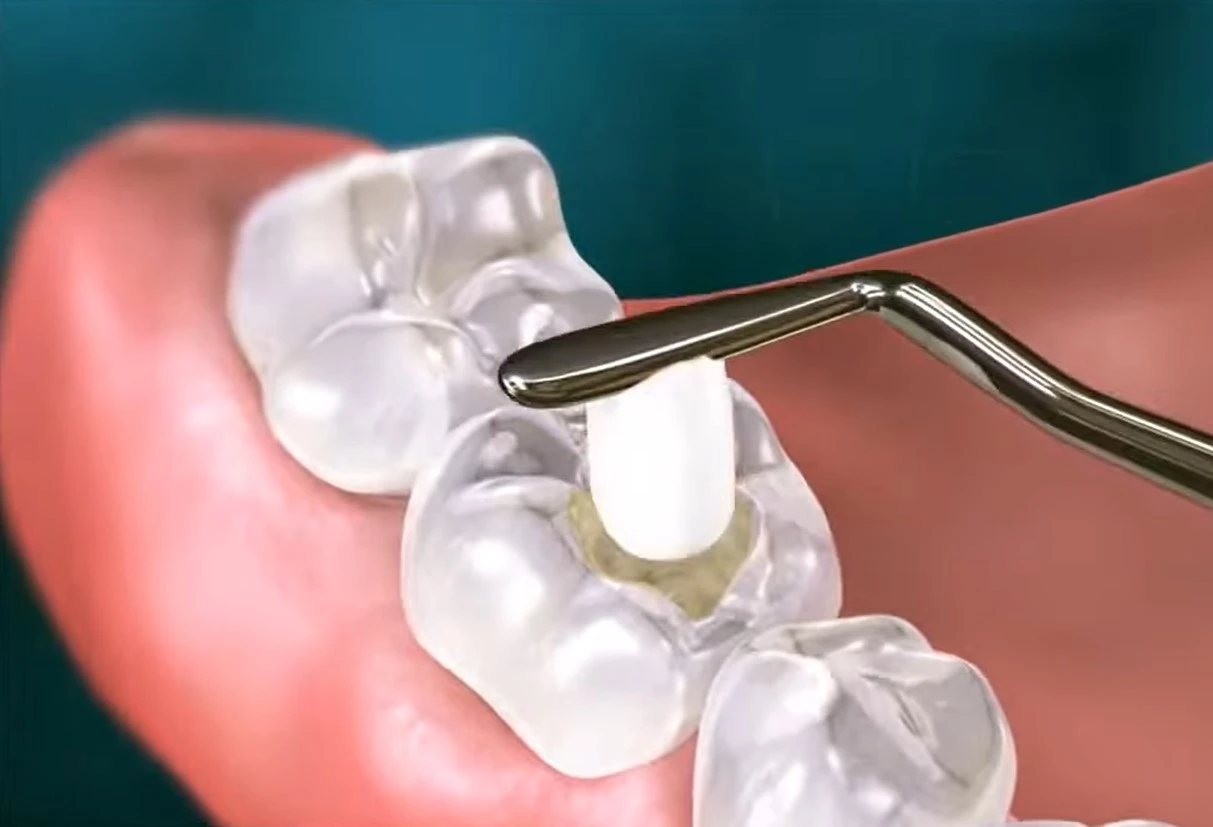 How Long Does It Take to Get a Cavity Filled?