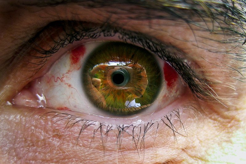 How Long Does It Take To Recover From LASIK?