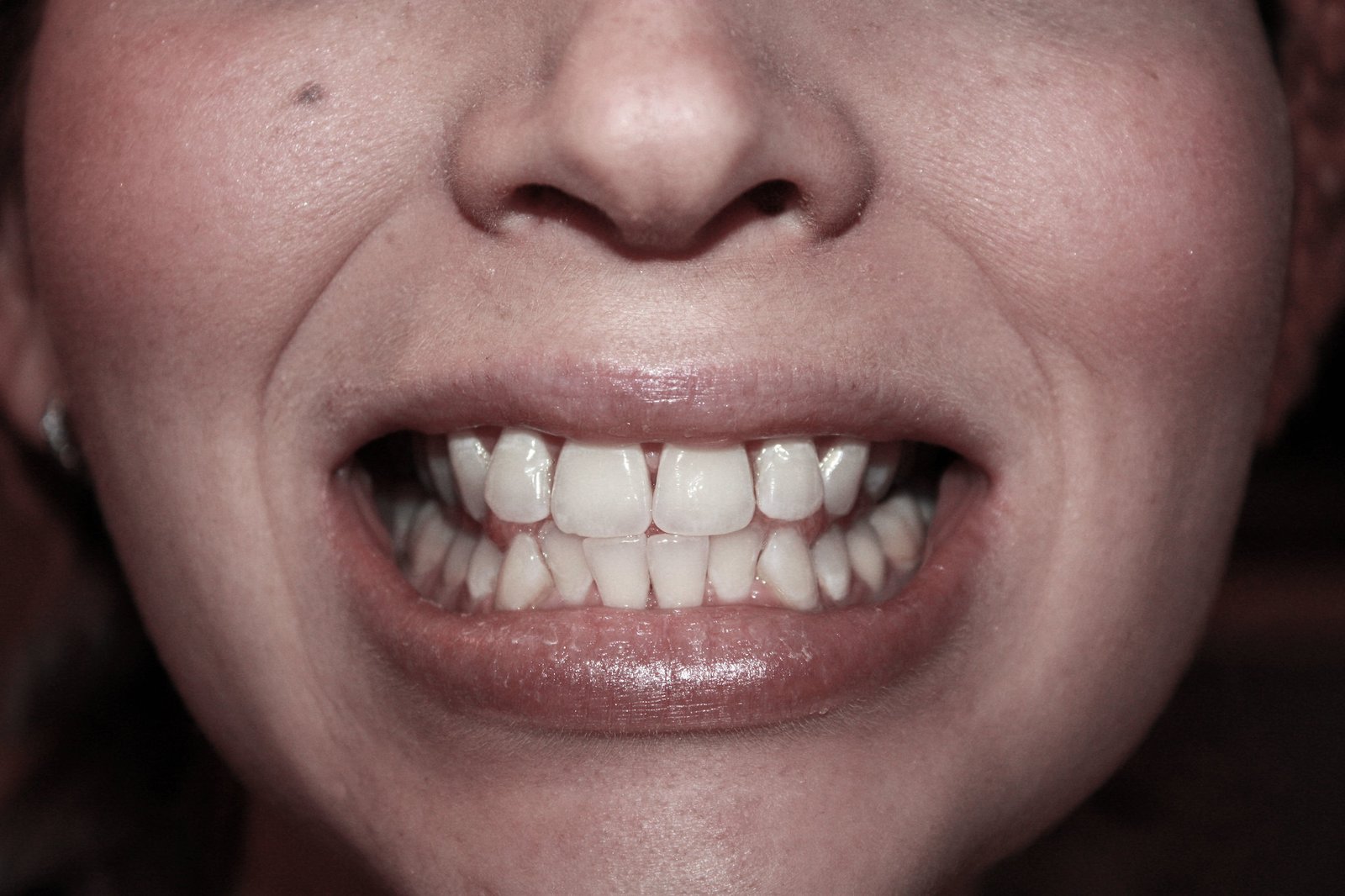 Why Does My teeth Hurt When I Bite Down?