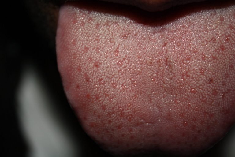 ridges on side of tongue