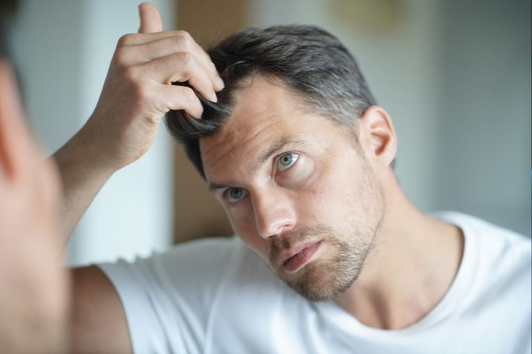 Scalp Eczema and hair loss-min