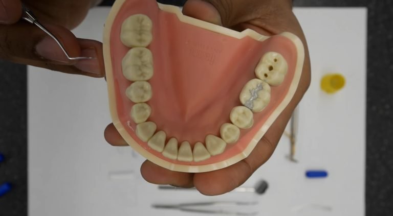 Amalgam Fillings