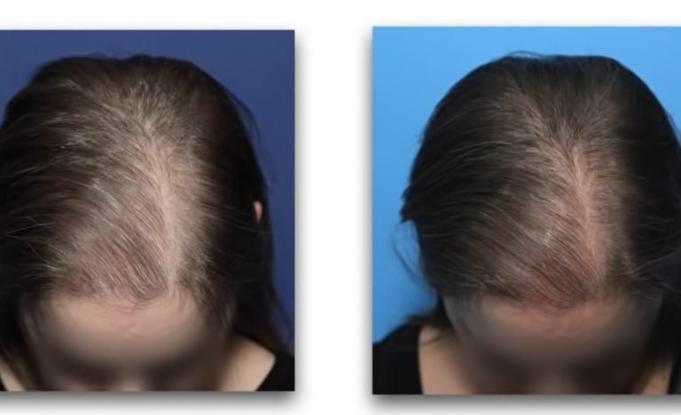 hair transplants a solution for women