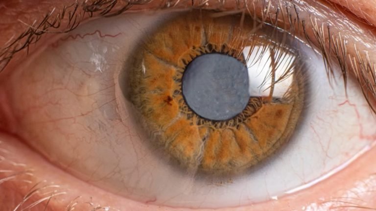 how long after cataract surgery can you bend over