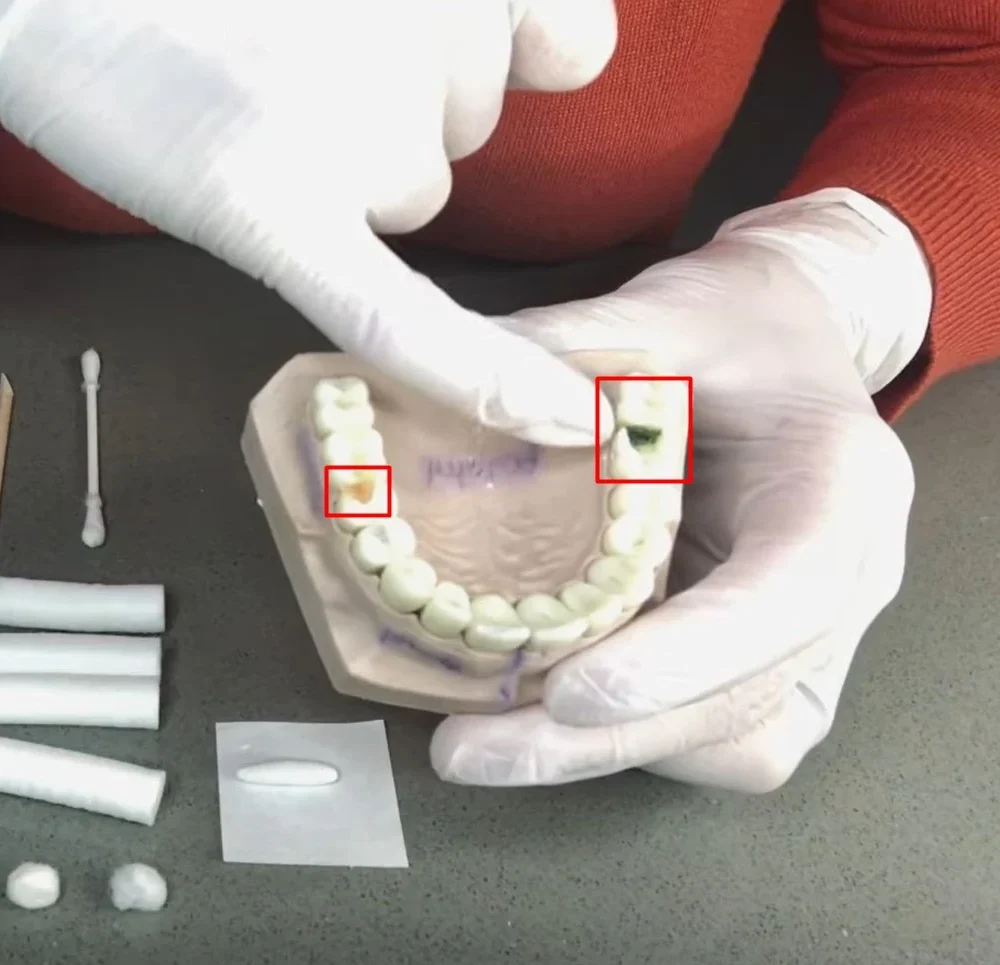 How Long Can You Leave A Cavity Untreated?