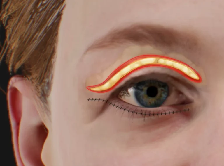 how to qualify for eyelid surgery