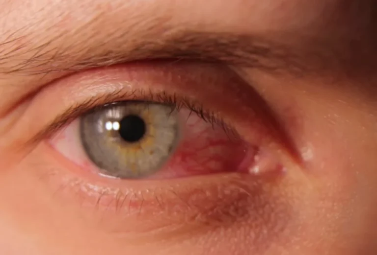 can a sinus infection cause pink eye