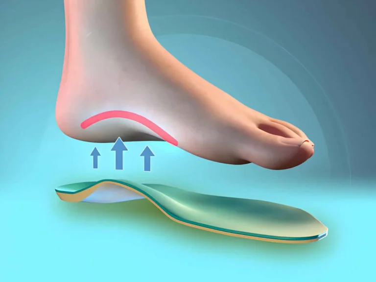 choosing the right arch support insoles