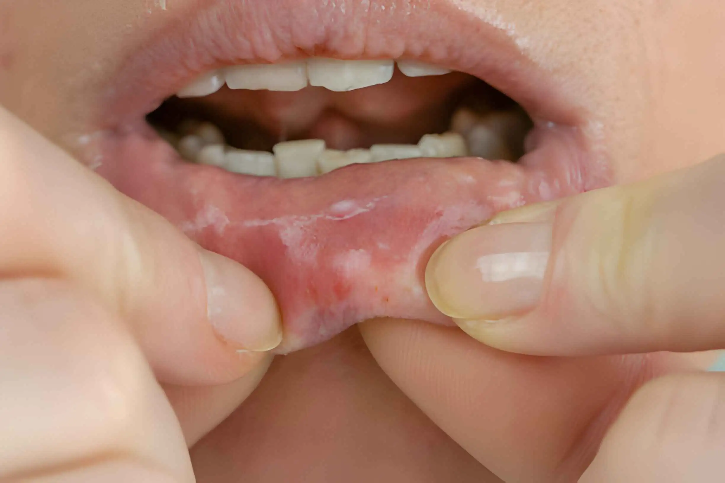 How To Stop Skin Peeling Inside Mouth? - CloudMineInc