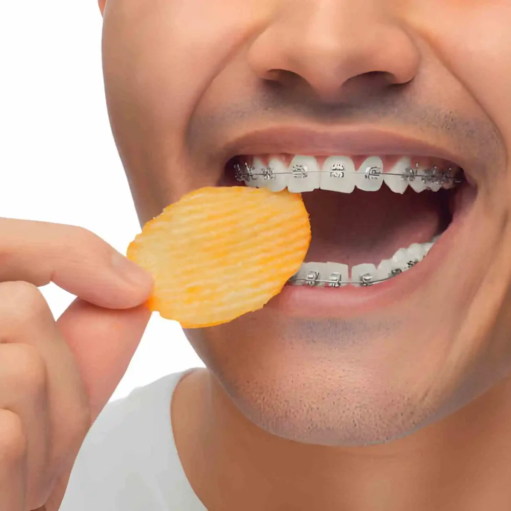 Can You Eat Chips With Braces?