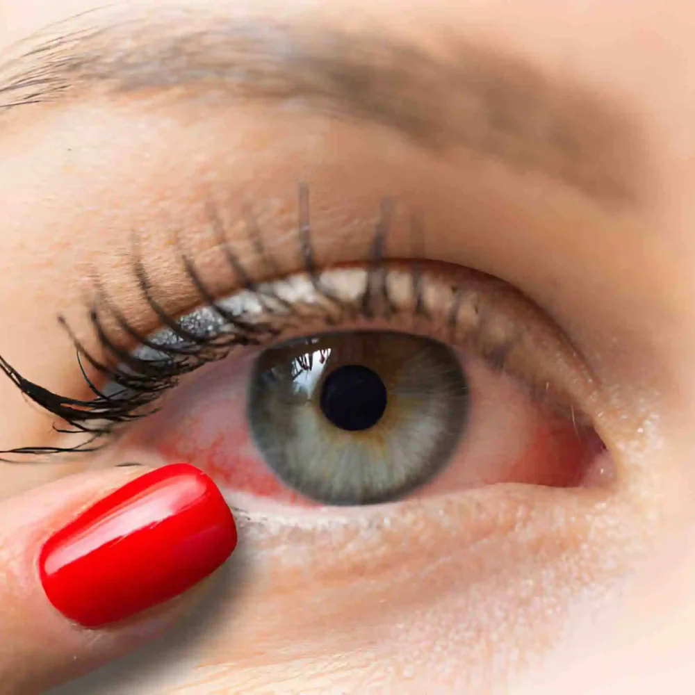 Common Conditions Mistaken for Pink Eye: Know The Difference