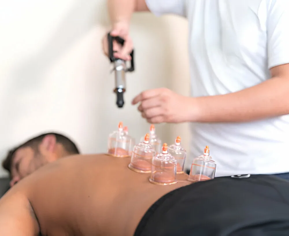 Acupuncture and Cupping: Enhancing Athletic Performance and Recovery
