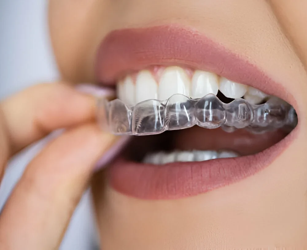 How Does Invisalign Work?