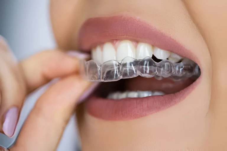 how does invisalign work