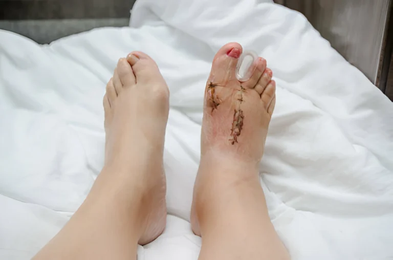 is bunion surgery worth it