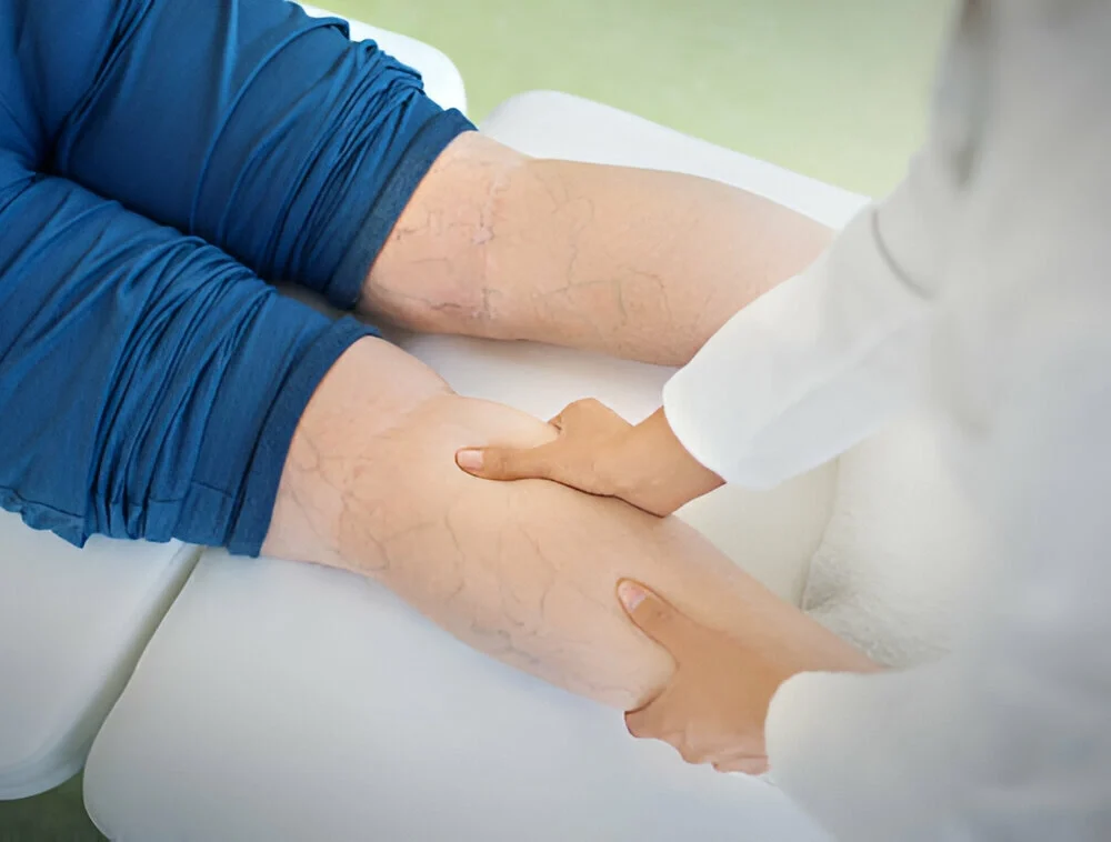 Inherited Traits: Understanding Varicose Veins and Genetics