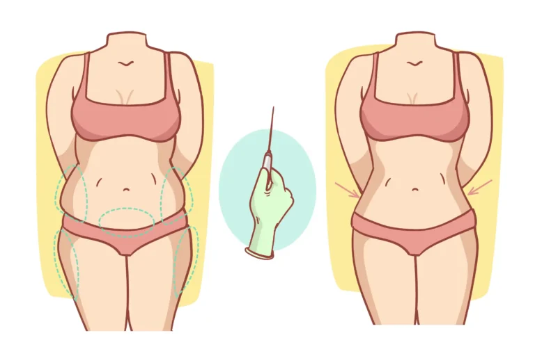 how to sleep after bbl and tummy tuck