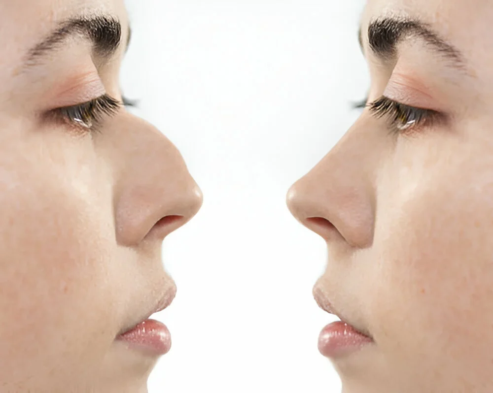 How To Get Rid of Bump on Nose